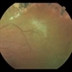 Sickle Cell Retinopathy with Sea Fans Sickle Cell Retinopathy with Sea Fans